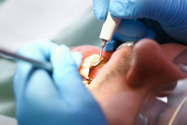 Best Emergency Dentist for Knocked-Out Tooth in Kathleen, FL